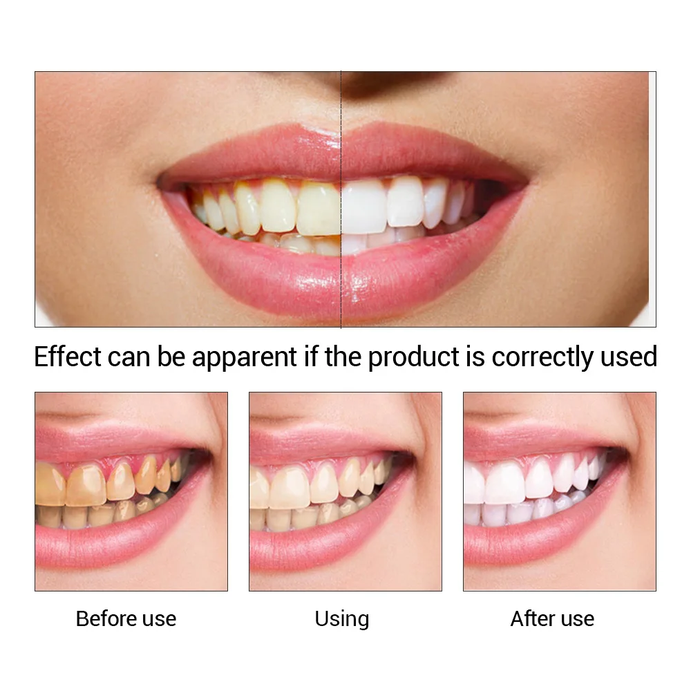 FTEENPLY Essência para claream - Teeth Whitening China avaliação e preço
