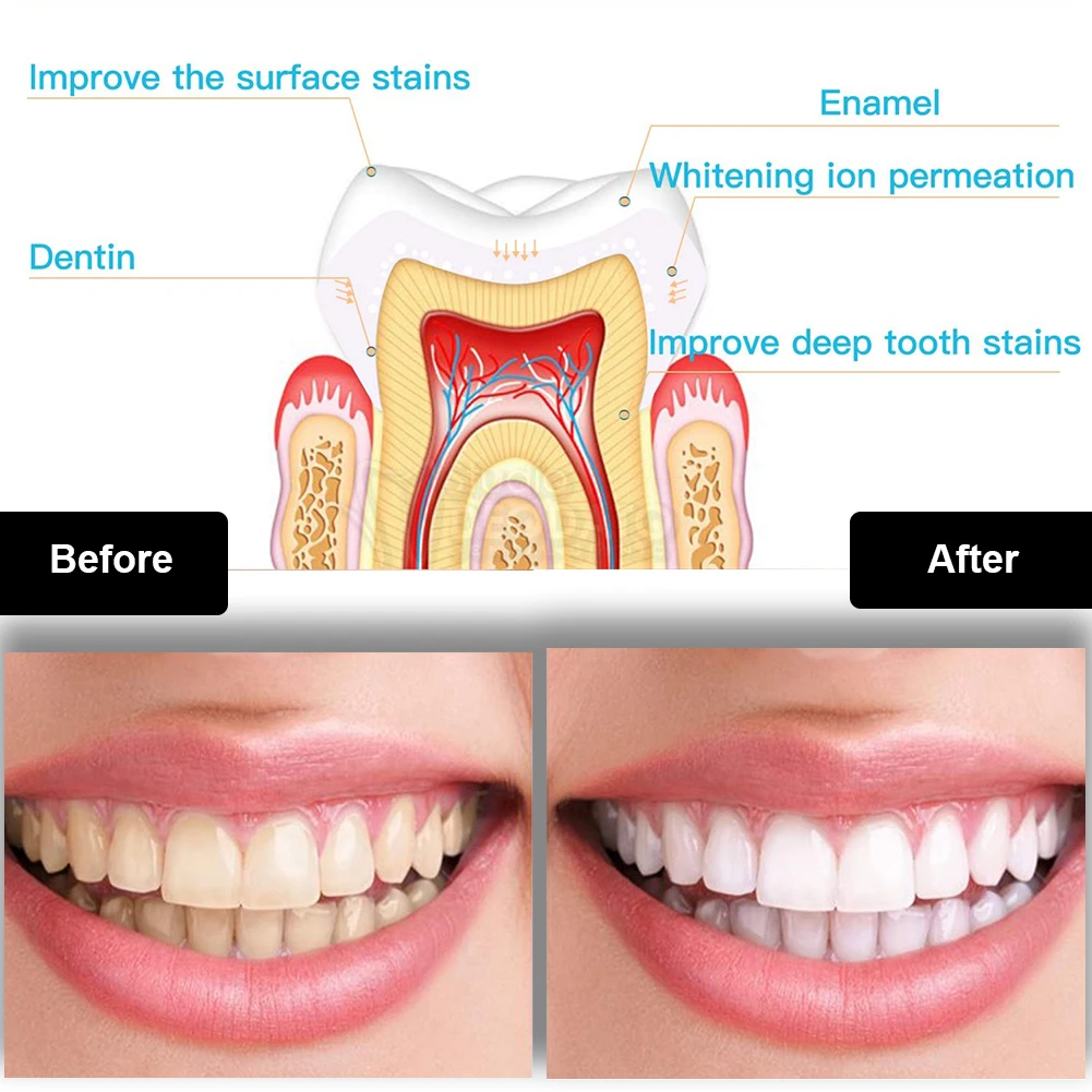 Kit de clareamento dental dos  - Teeth Whitening Light Kit avaliação e preço
